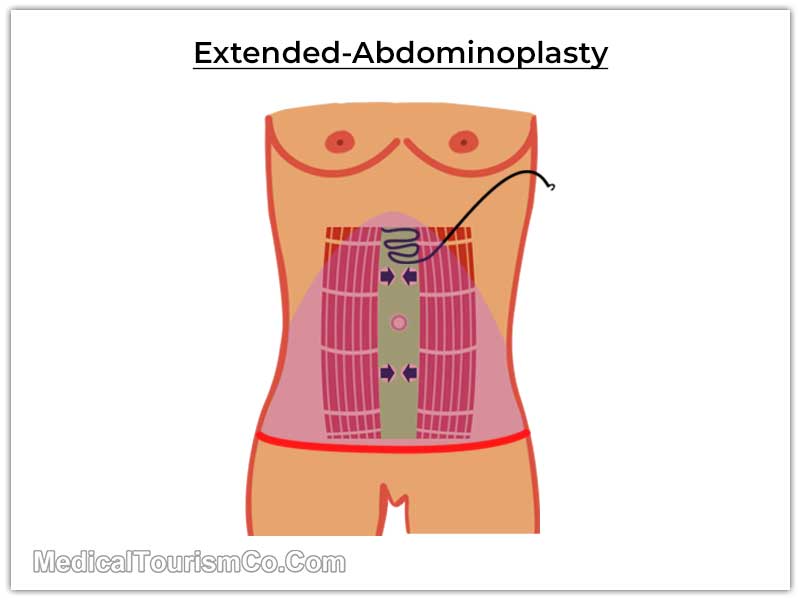 Extended-Abdominoplasty