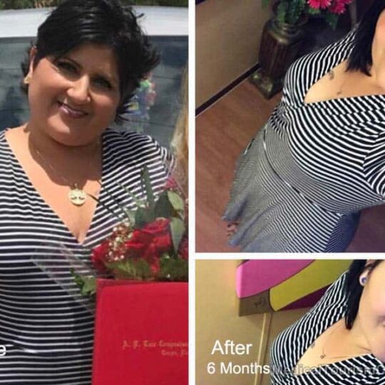 Gastric Sleeve Tijuana Mx Before After 6 months