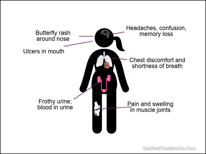 Lupus-Symptoms-Stem-Cell