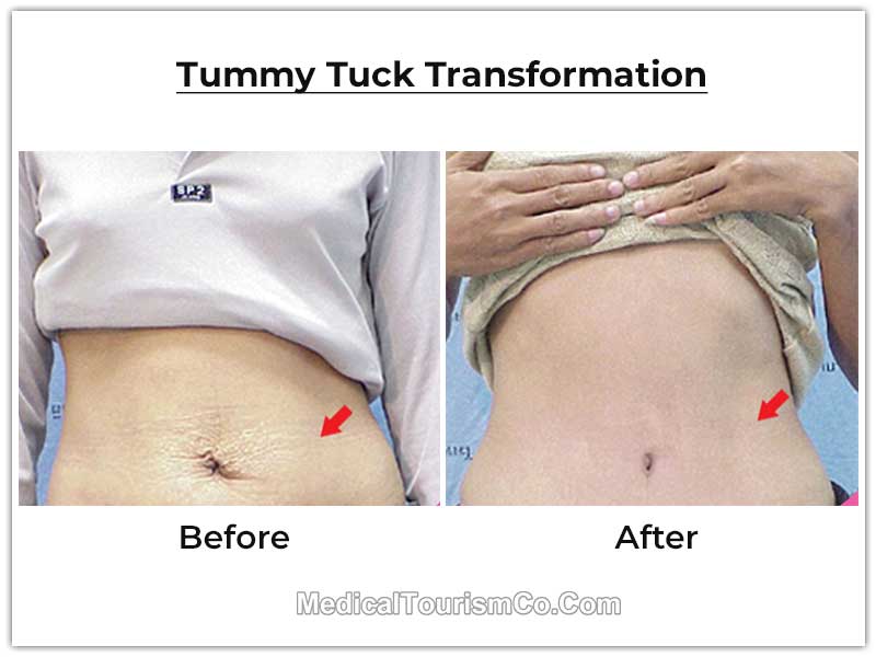 Tummy Tuck Tijuana Mexico Before After