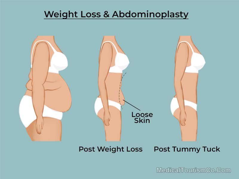 Weight-Loss-and-Abdominoplasty