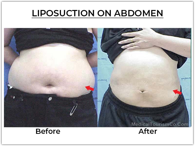 Liposuction Tijuana Before After Abdomen