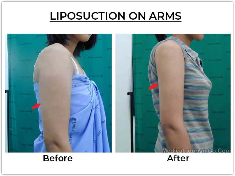 Liposuction Tijuana Mexico Before After Arms