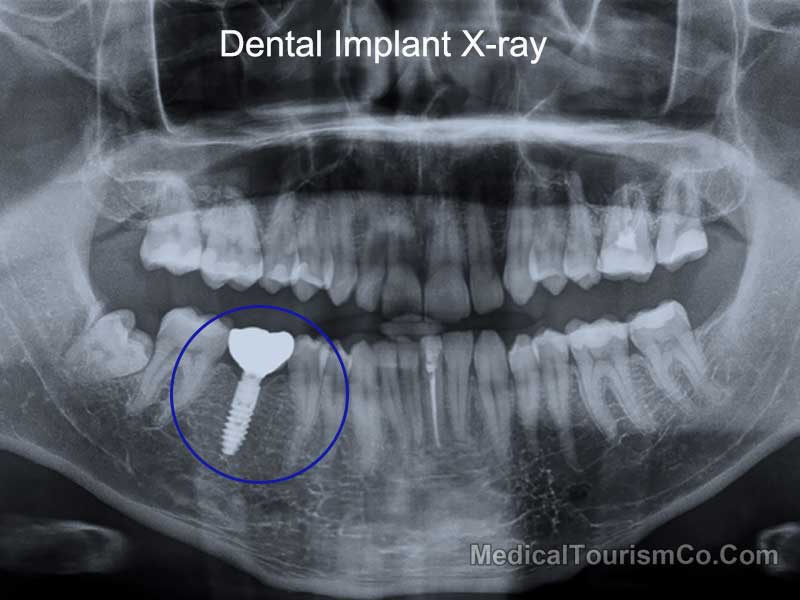 Dental Implant X-Ray