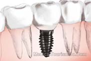 Single Tooth Implant Mexico