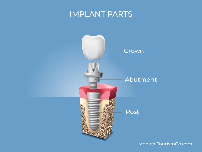 Dental Implants Phuket
