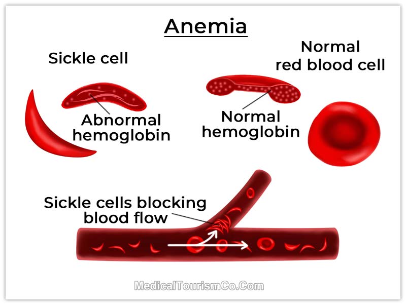 Stem Cell Therapy Sickle Cell Anemia in Mexico