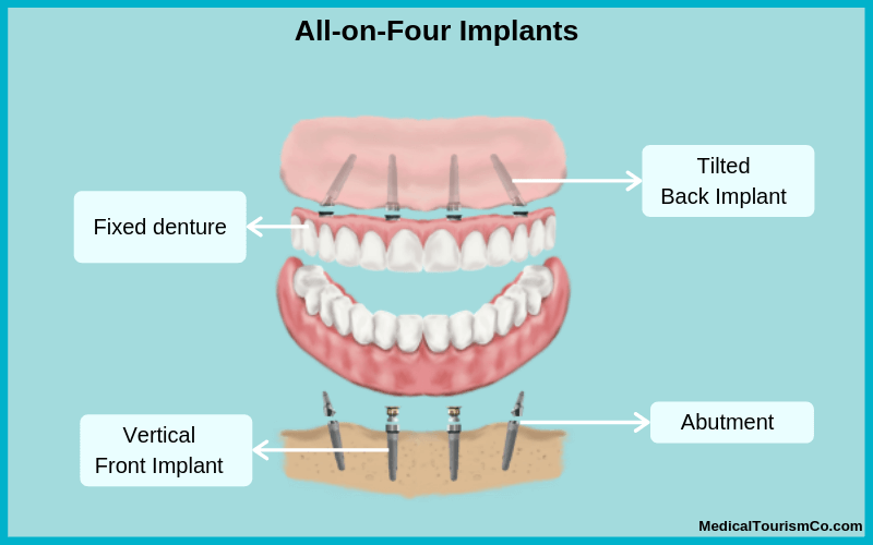 What are All-on-4 implants