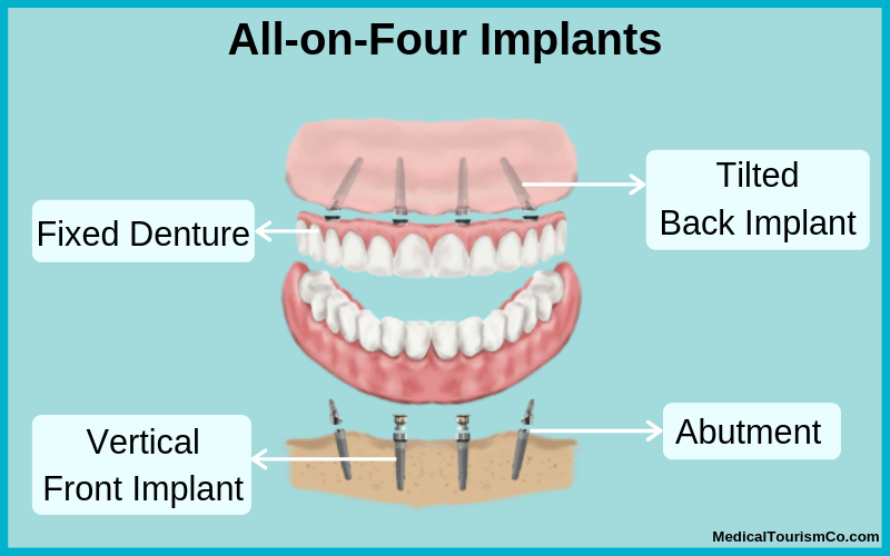 what are All-on-4 implants