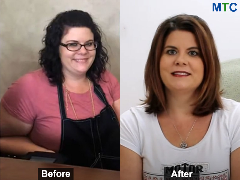 Before & After after revision bariatric surgery in Mexico