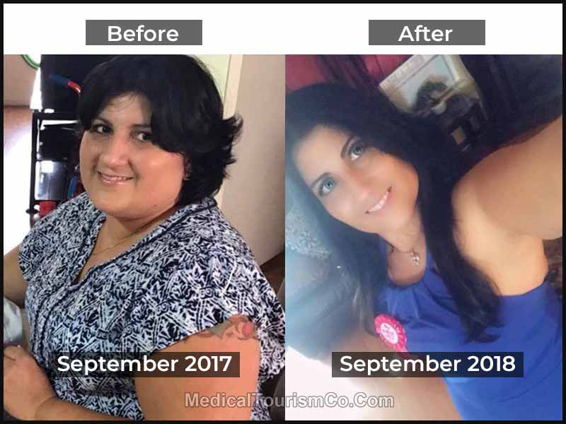Mexico Bariatric Surgery-Before and After Pic