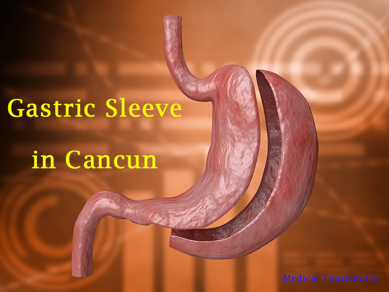 Gastric Sleeve in Cancun