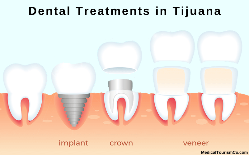 dental treatments in Tijuana