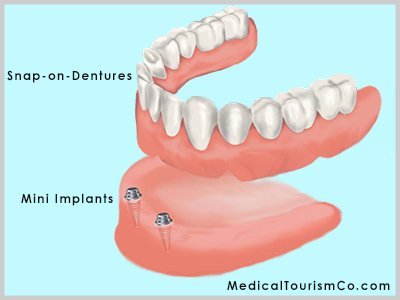 Snap-on-Dentures- India