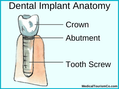 Dental implant anatomy