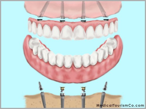 All-on-4 Implants based dentures- Fixed Dentures Abroad