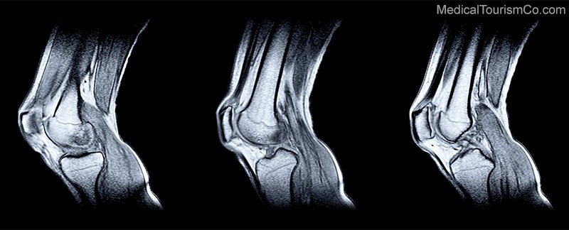 MRI of knee