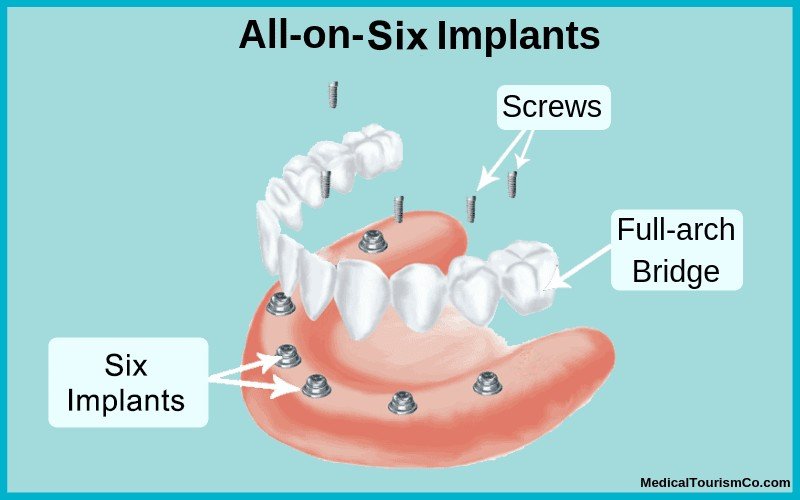 All-on-6 implants