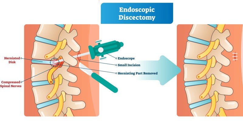 endoscopic discectomy - Spine Surgery India