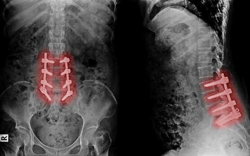 Post-surgery X-ray of spinal fusion surgery