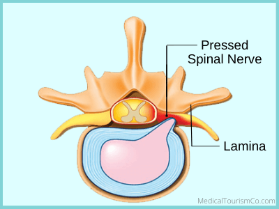 spinal fusion may be done with laminectomy
