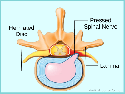 herniated disc may require spine surgery