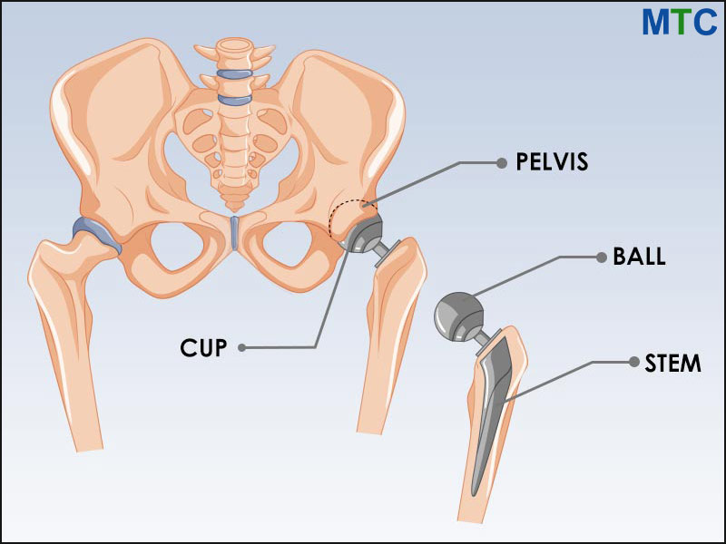 Hip Replacement Implants