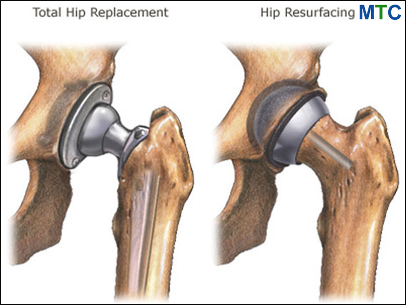 Total hip replacement vs Hip resurfacing