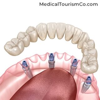 All on 4 Implants | Dental Implants in Cartagena