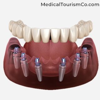 All on 6 Implants | Dental Implants in Cartagena