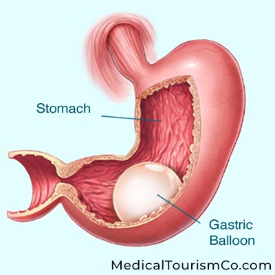 Gastric Balloon Placement in Mexicali