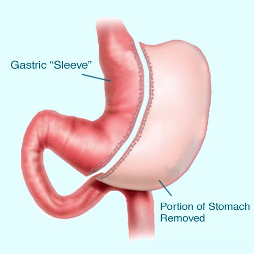 Gastric Sleeve- Bariatric Surgery in Mexicali