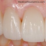 Zirconia Crowns in Cabo