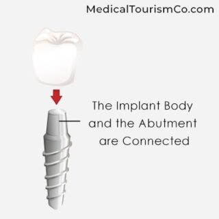 Zirconia Implant | Dental Implants in Cartagena