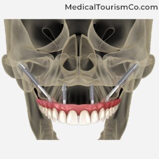 Zygomatic Implant | Dental Implants in Cartagena