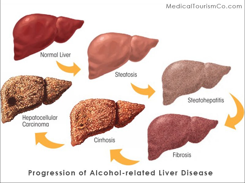 Stem cell for alcohol-related liver disease-Prrogression stages