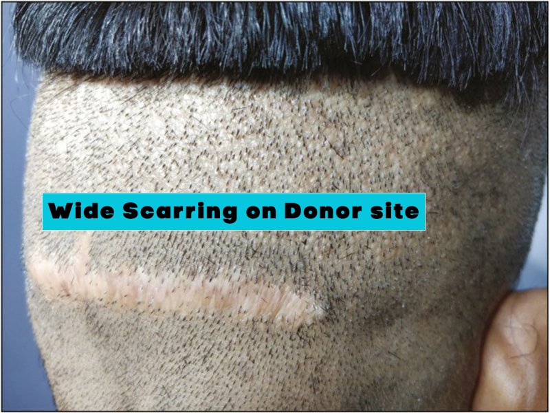 Side effects of Hair Transplant