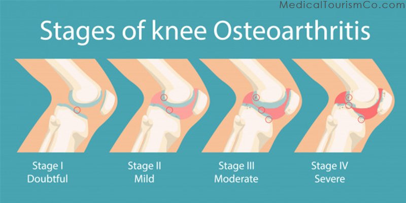 Stages of Osteoarthritis