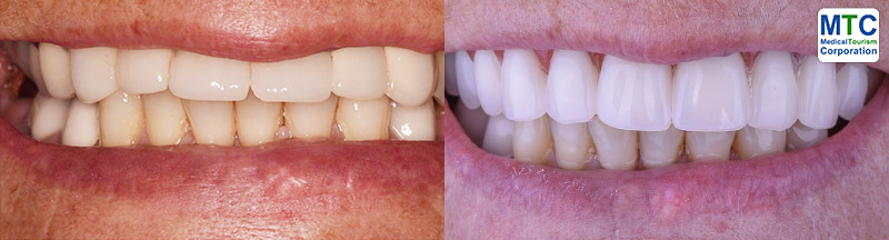 Costa Rica Dental Veneers - Before Placing (L) and After Placing (R)
