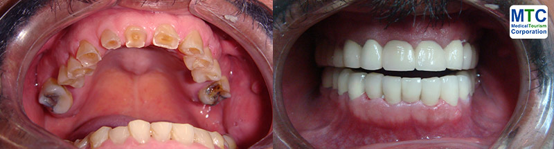 Dental Bridge - Before Placing and After Placing