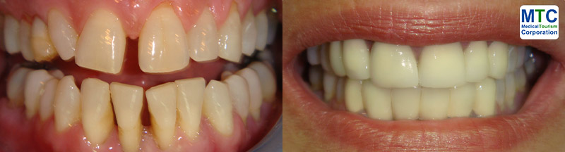 Costa Rica Dental Crowns - Before Placing (L) and After Placing (R)