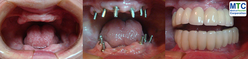 Costa Rica Dental Implants - Before Implant, Before Crown, After Implant