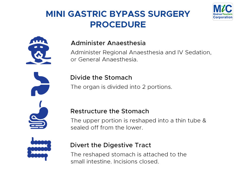Mini Gastric Bypass Procedure | Nuevo Laredo | Mexico