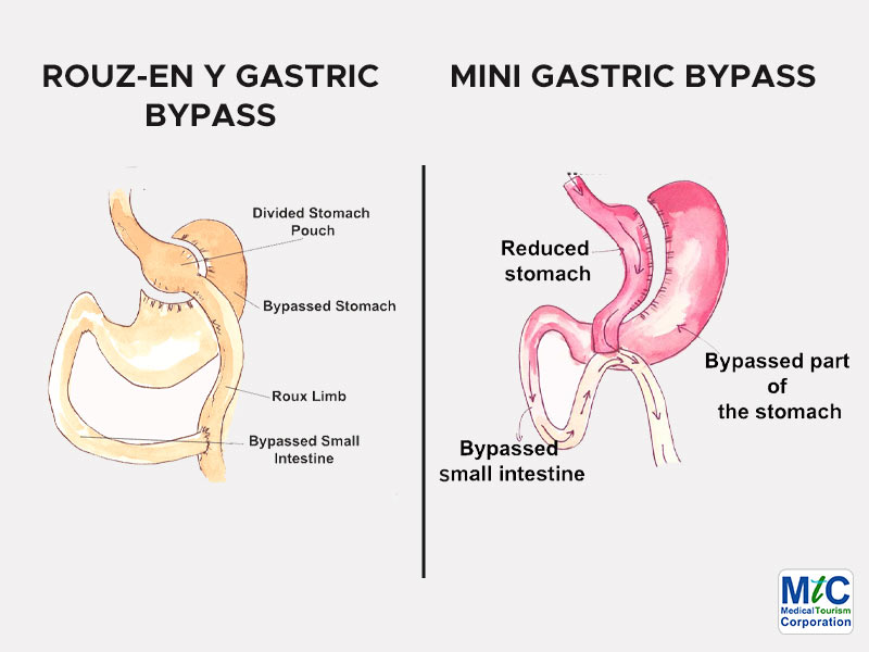 Gastric Bypass vs. Mini Gastric Bypass | Nuevo Laredo, Mexico