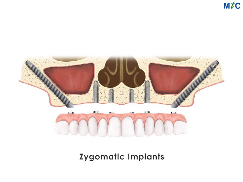 Zygomatic Implants in Los Algodones