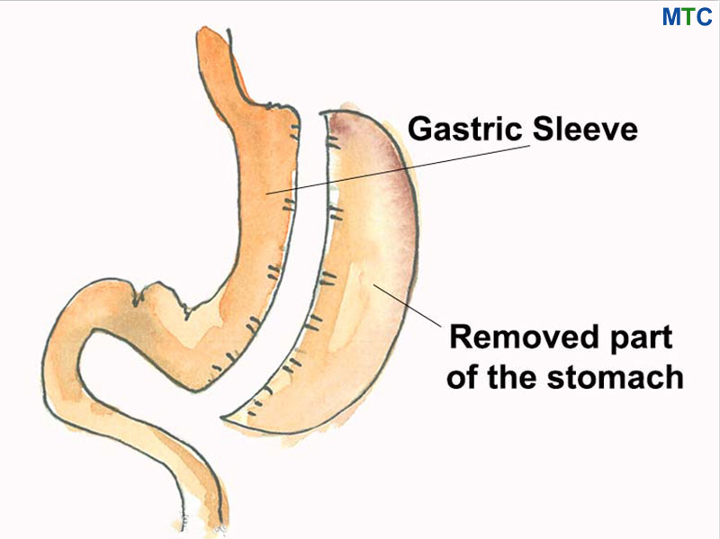 Gastric Sleeve Surgery in Cancun, Mexico