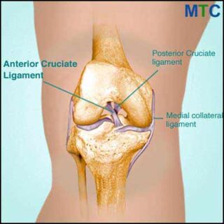 ACL knee replacement