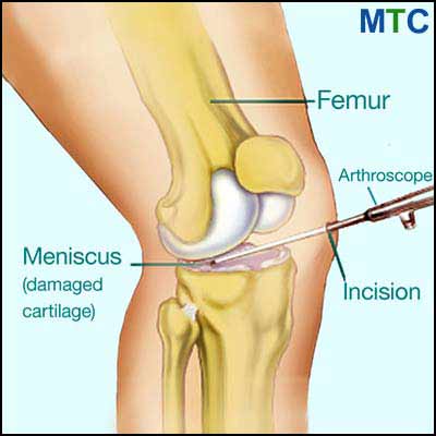 Knee meniscus surgery
