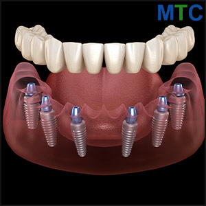 All-on-6 Dental Implants in Hungary