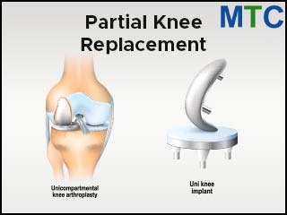 Partial Knee Replacement in Puerto Vallarta